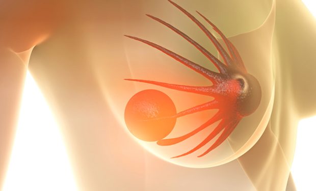 Women with breast cancer risk opting out of tamoxifen therapy